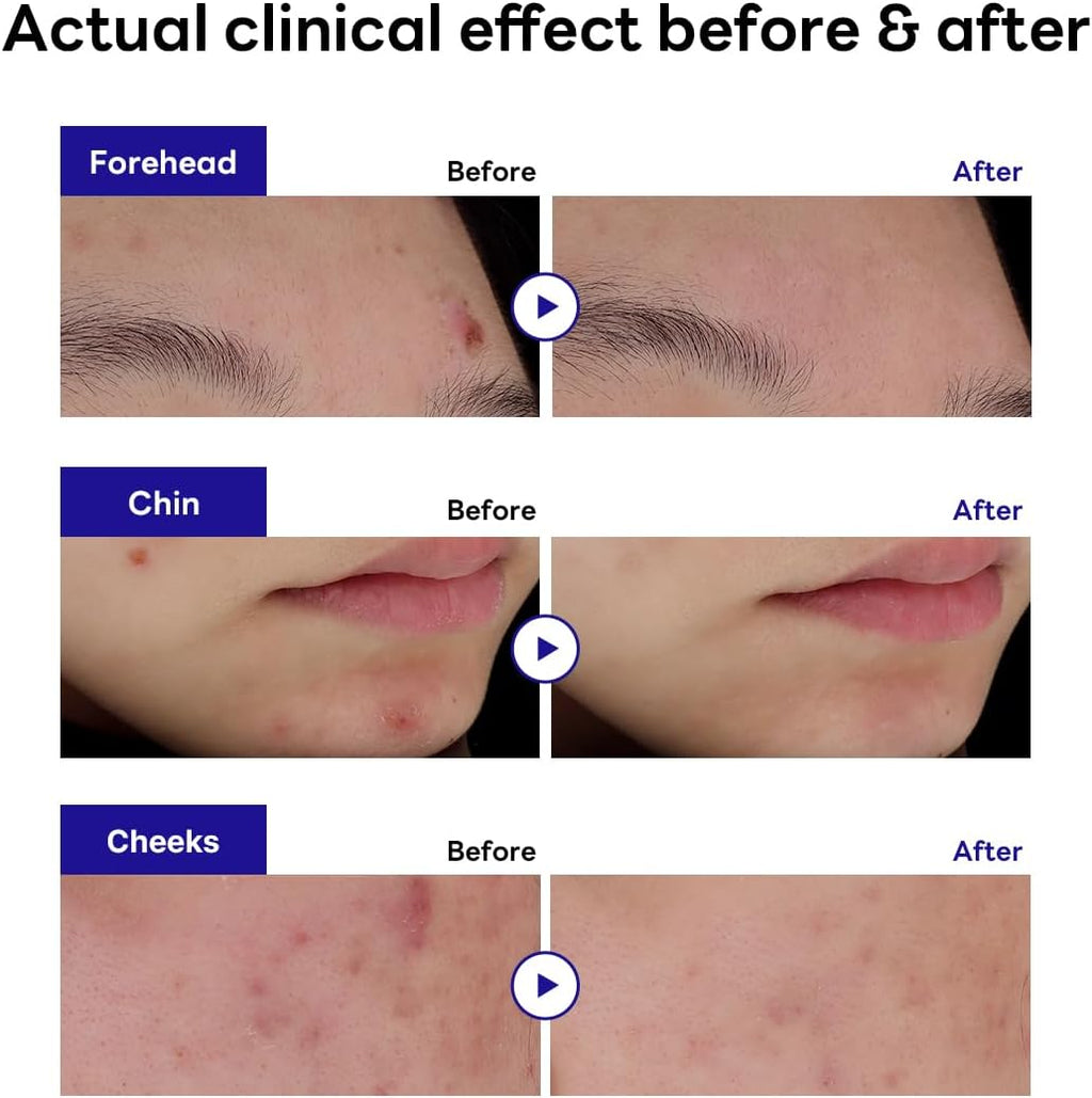 Derma Clear Madecassoside Blemish Patch (44 Counts)